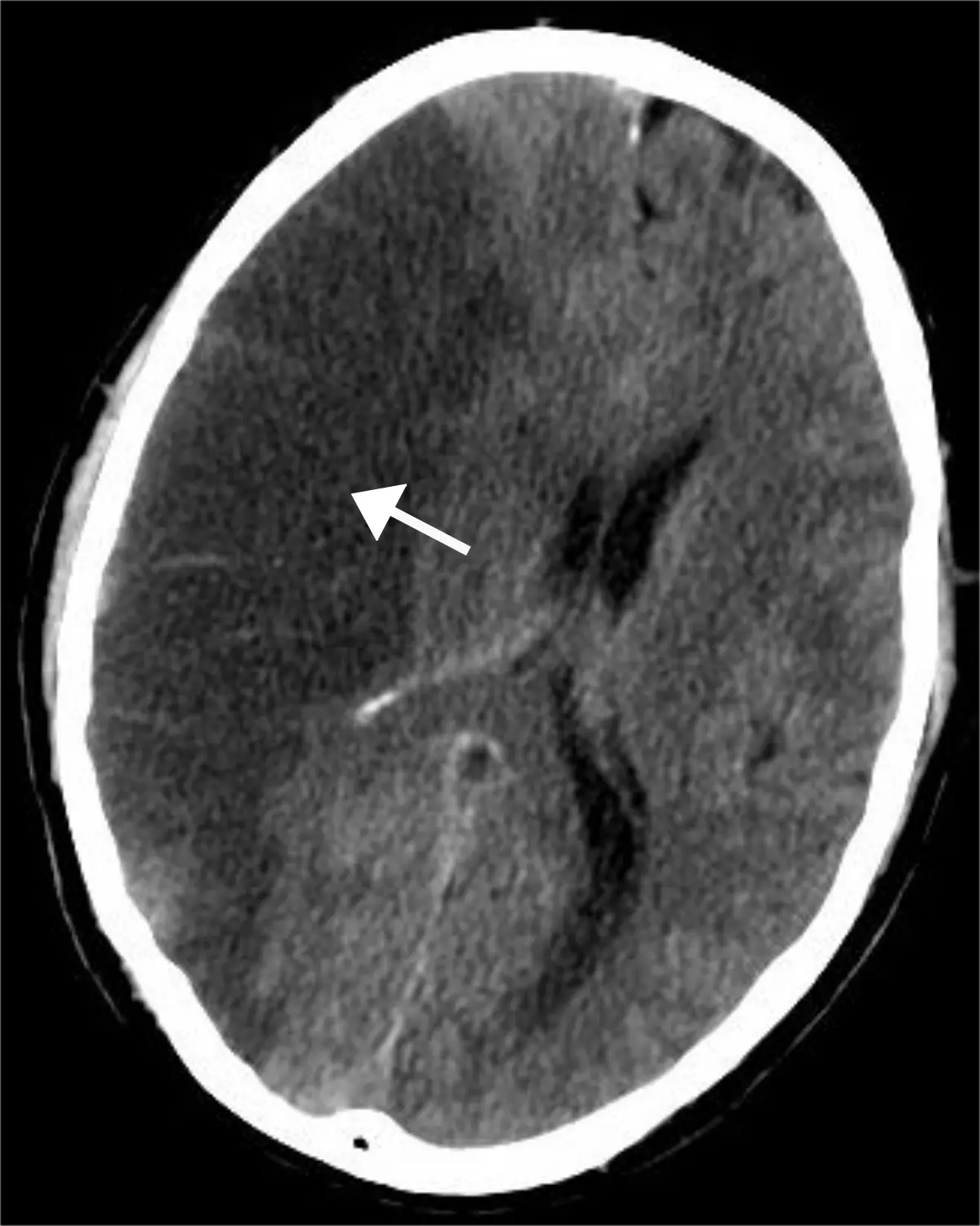 Ischemic stroke of the brain