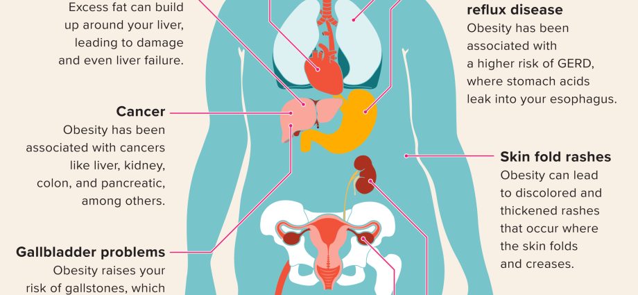 It affects every 4th of us. Six diseases that obesity can make us into