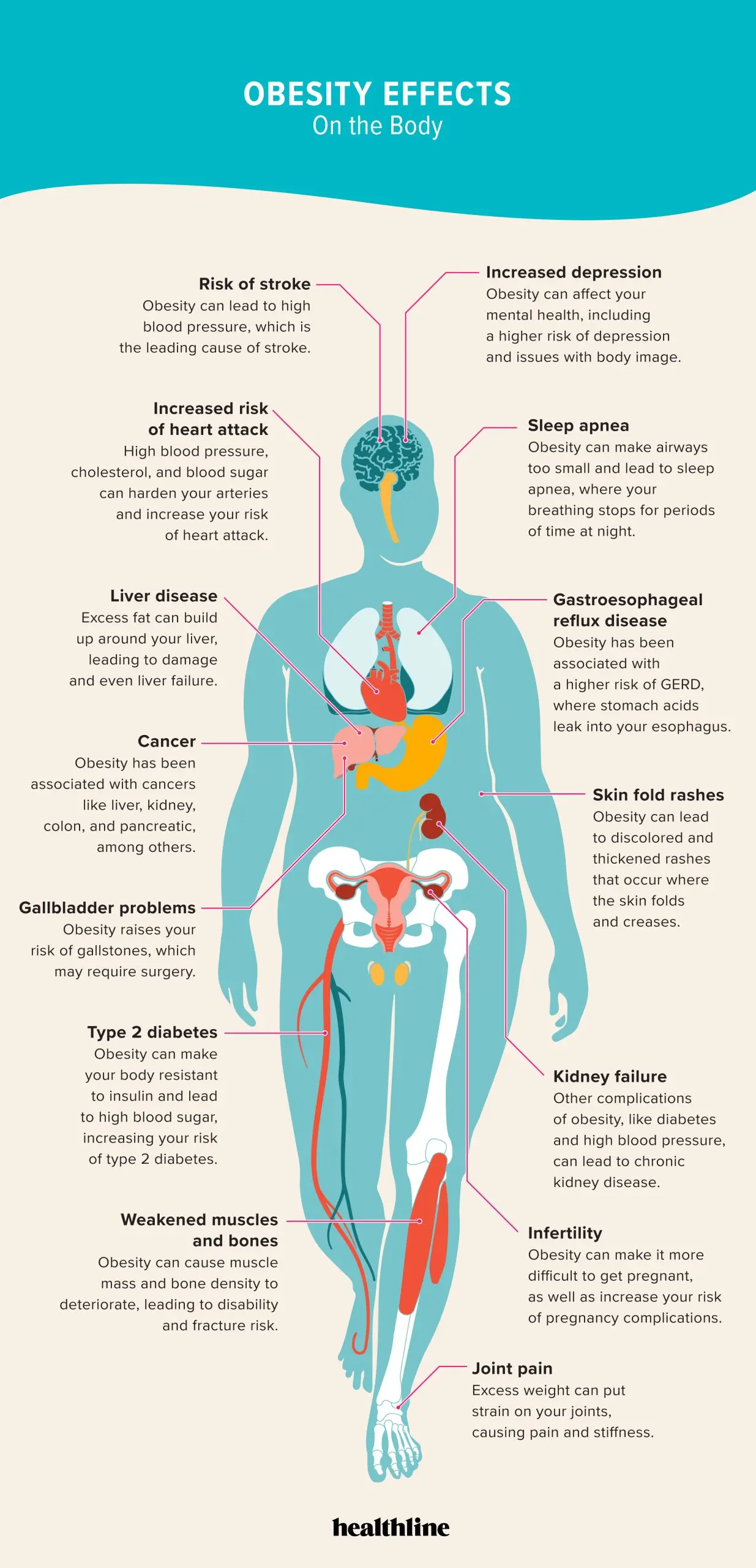 It affects every 4th of us. Six diseases that obesity can make us into