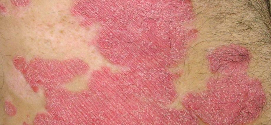 It is a dangerous cancer. At first, it looks like red, scaly skin