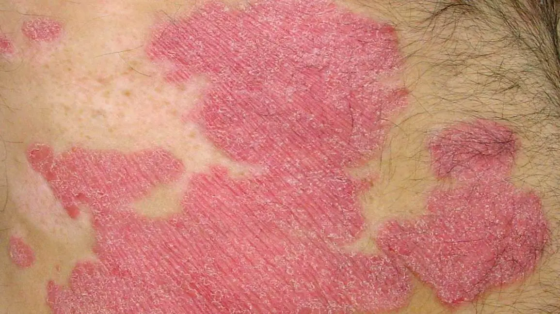 It is a dangerous cancer. At first, it looks like red, scaly skin