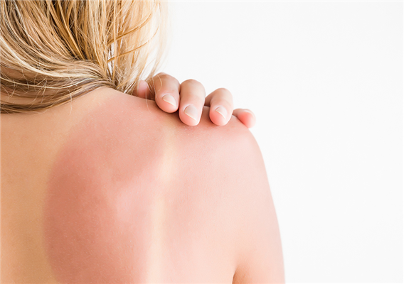 It is the most popular remedy for sunburn. Pharmacist: don&#8217;t be fooled