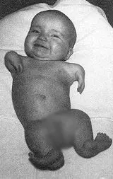 It was supposed to be a safe pain reliever and sedative. Thalidomide caused damage to almost 15. fetuses