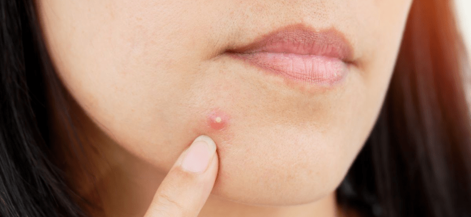 It&#8217;s just a pimple? Not necessarily. This is how cancer can manifest itself