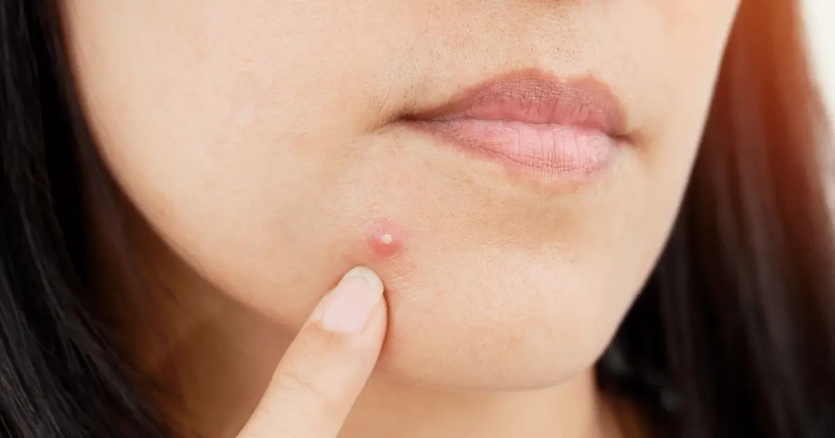 It&#8217;s just a pimple? Not necessarily. This is how cancer can manifest itself