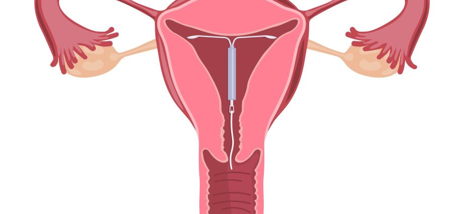 IUD &#8211; is it 100% sure? Advantages and disadvantages of placing an intrauterine coil