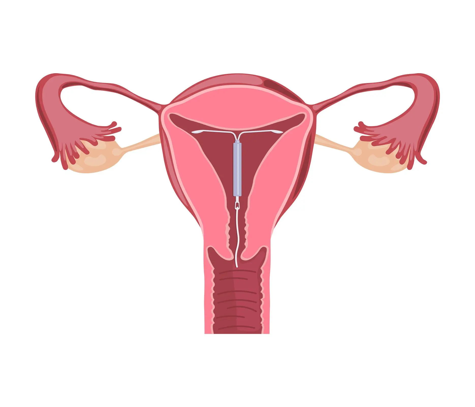 IUD &#8211; is it 100% sure? Advantages and disadvantages of placing an intrauterine coil