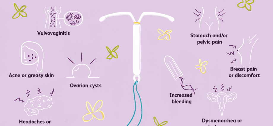 IUD &#8211; types, side effects, price