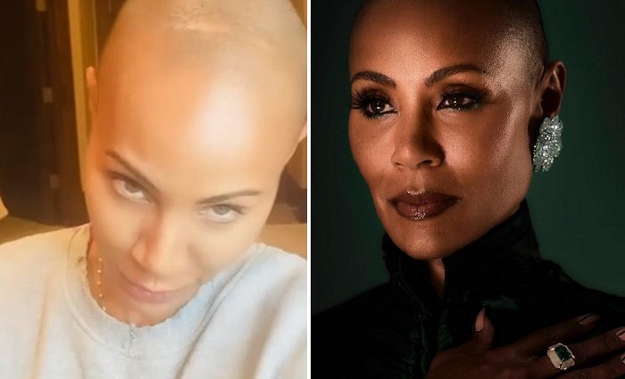 Jada Pinkett Smith suffers from alopecia areata. He has been talking about it for years