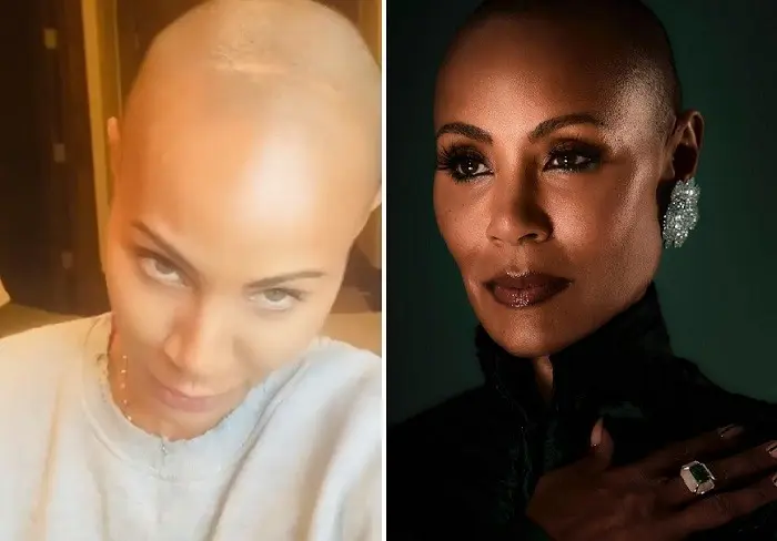 Jada Pinkett Smith suffers from alopecia areata. He has been talking about it for years