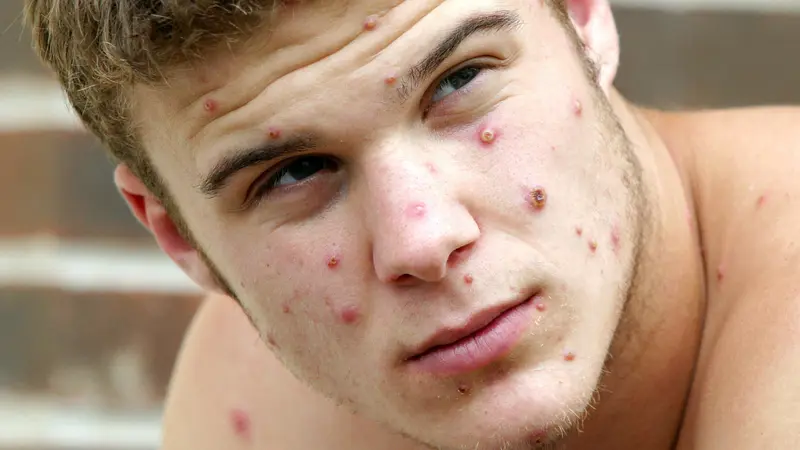 James fell ill with monkey pox. He didn&#8217;t have a rash. Those were the symptoms