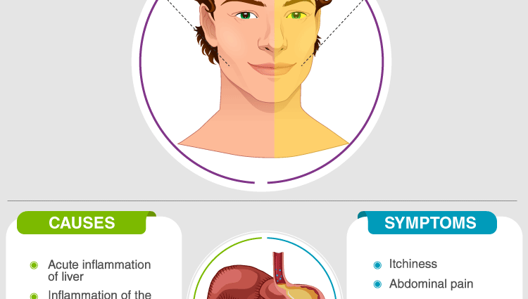 Jaundice &#8211; types, symptoms, causes, prevention [WE EXPLAIN]