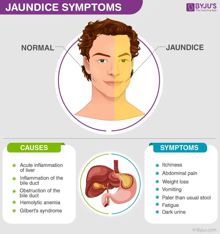 Jaundice &#8211; types, symptoms, causes, prevention [WE EXPLAIN]