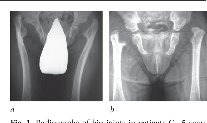 Joint dislocation &#8211; traumatic, congenital, pathological