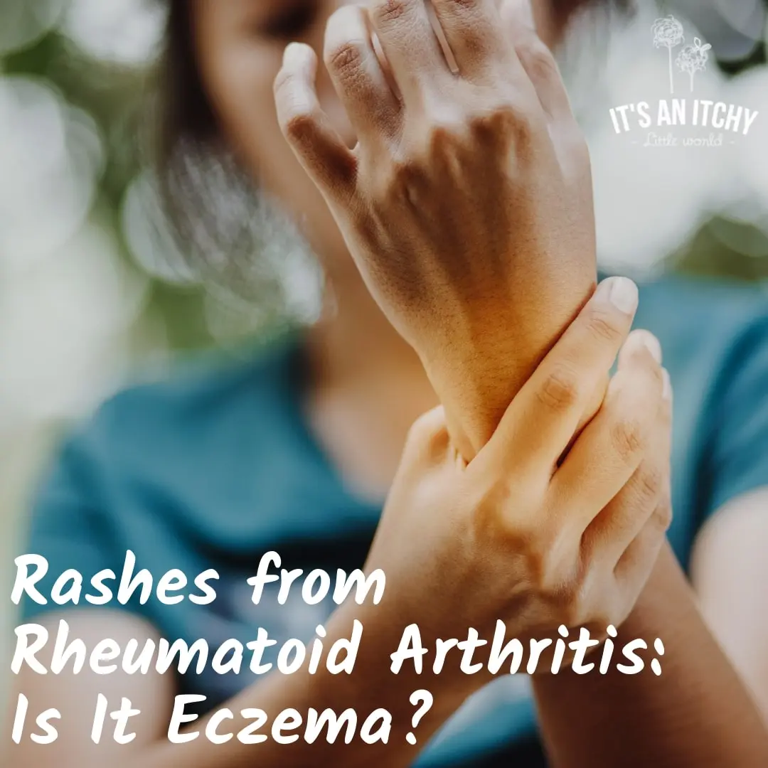 Joint remedy helps with eczema