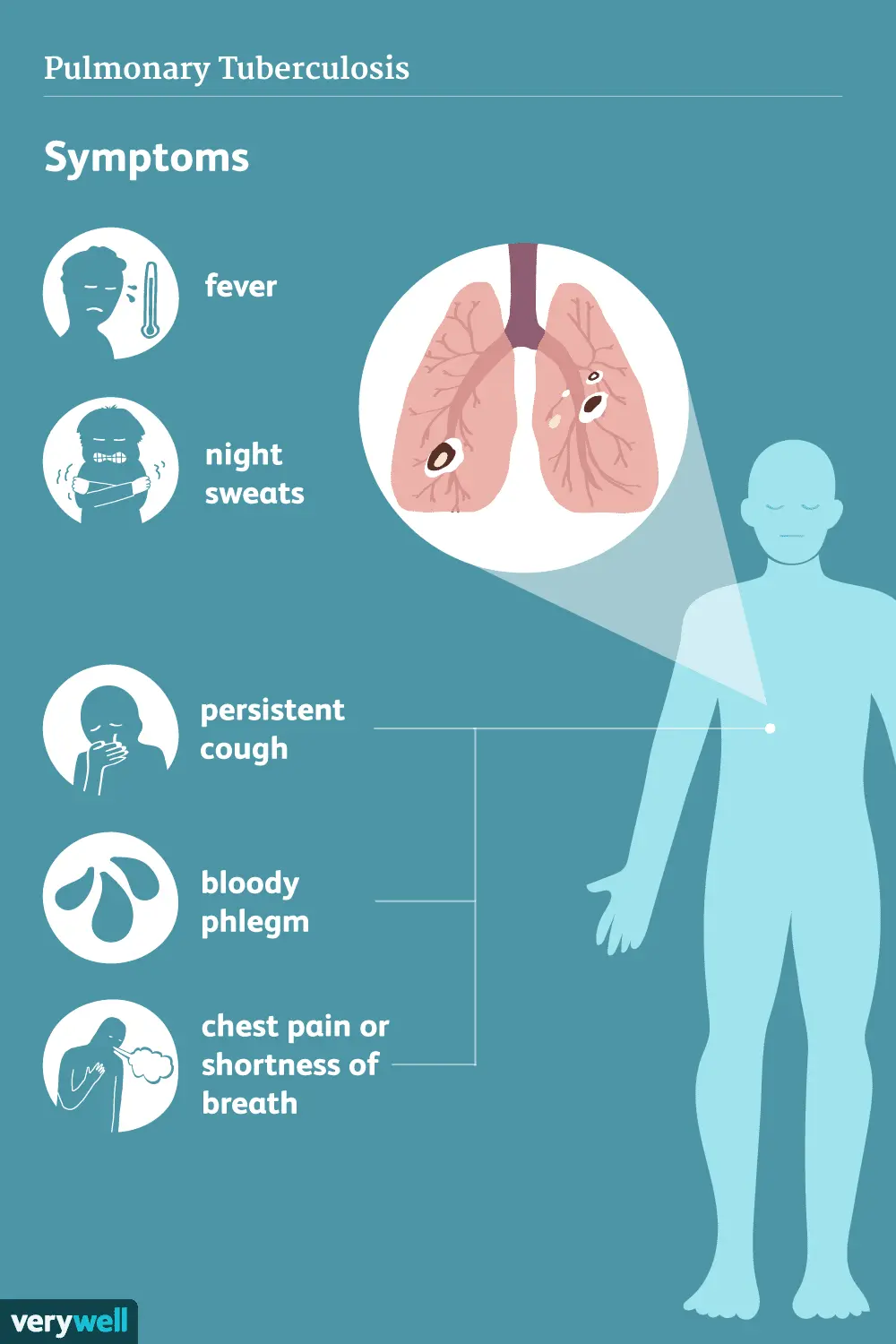 Joint tuberculosis &#8211; symptoms, diagnosis and treatment