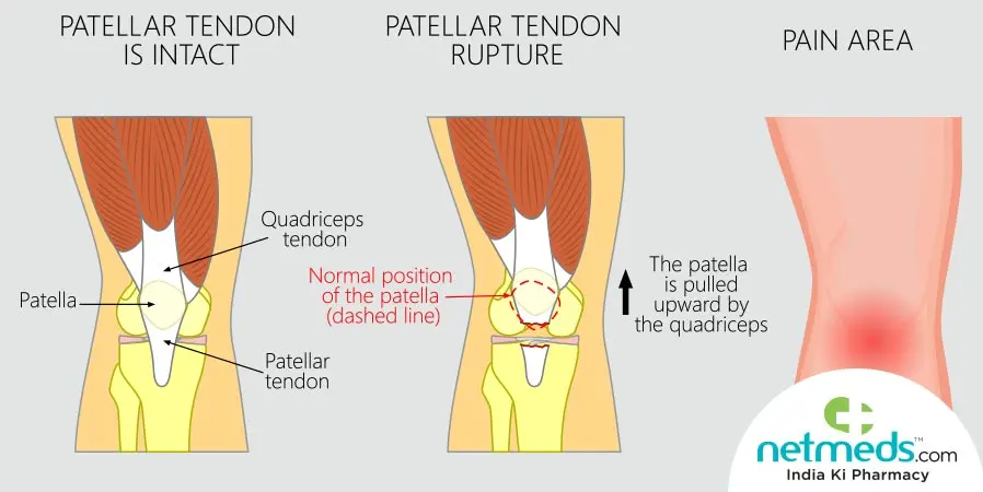 Jumper&#8217;s knee &#8211; causes, symptoms, method of treatment