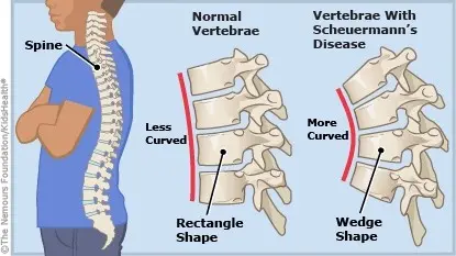 Juvenile Kyphosis (Scheuermann&#8217;s Disease)