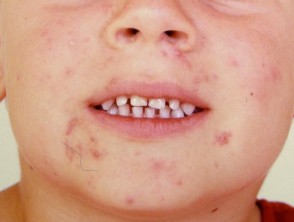 Juvenile or common acne