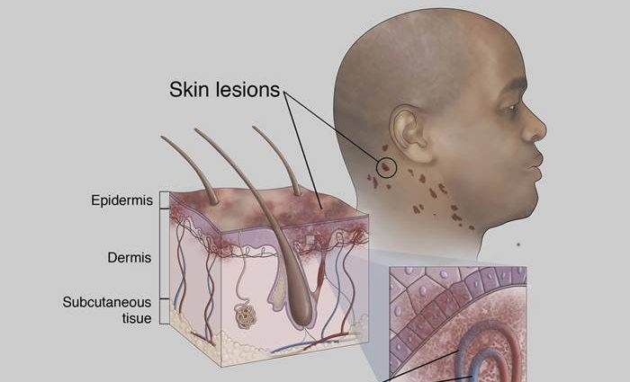 Kaposi&#8217;s sarcomas &#8211; causes, types, symptoms