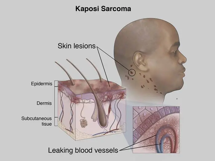 Kaposi&#8217;s sarcomas &#8211; causes, types, symptoms