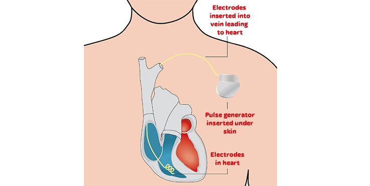 Kardiowerter &#8211; a device that saves a sick heart. How it works?