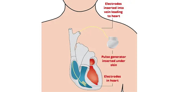 Kardiowerter &#8211; a device that saves a sick heart. How it works?