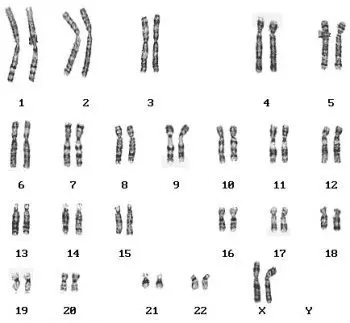 Karyotype &#8211; indications, the course of the examination. What does an abnormal karyotype mean?