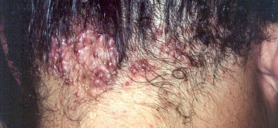 Keloic acne &#8211; causes, symptoms and treatment