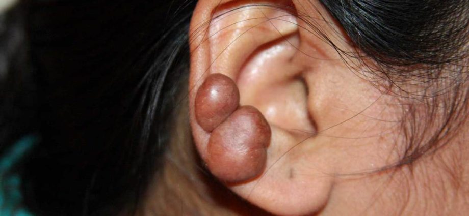 Keloid &#8211; causes, symptoms and treatment