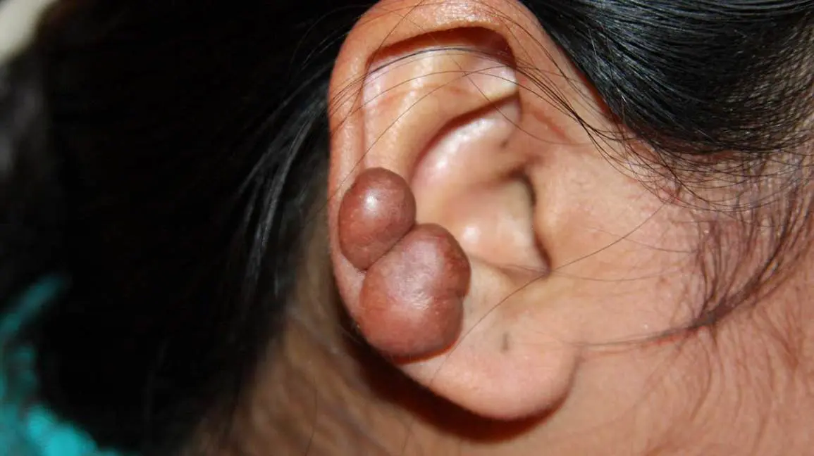 Keloid &#8211; causes, symptoms and treatment