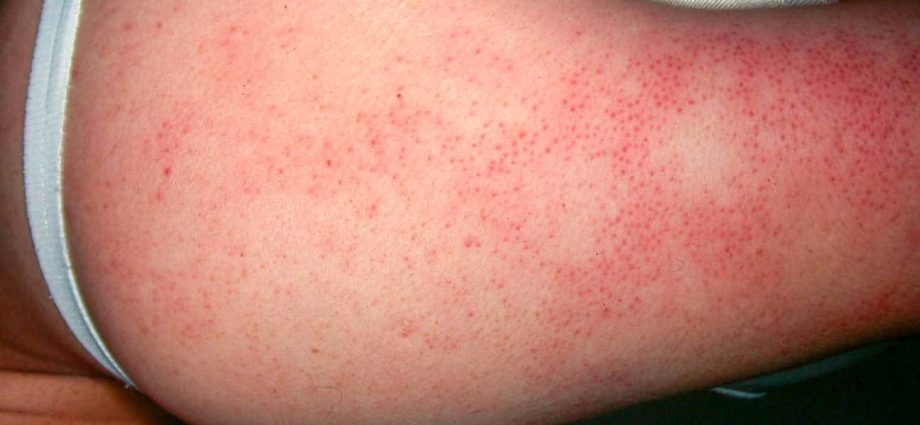 Keratosis disorders &#8211; what are they? What is the treatment like?