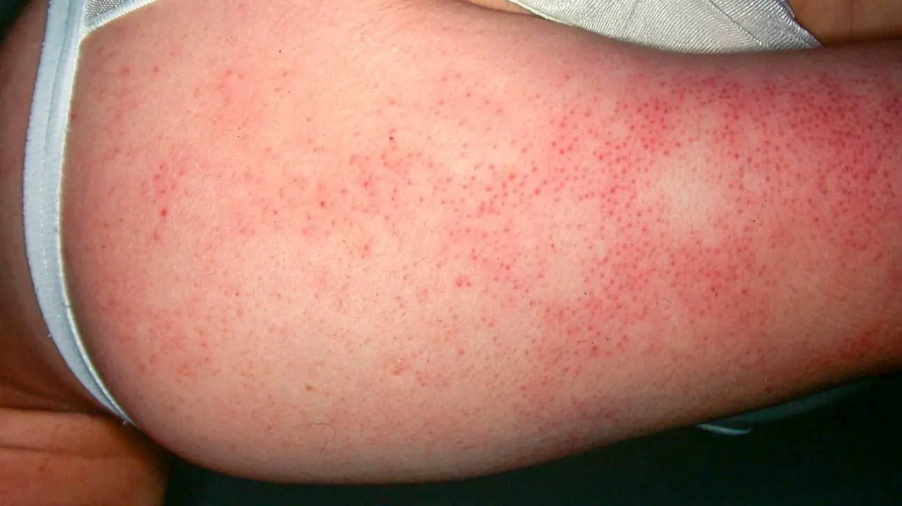 Keratosis disorders &#8211; what are they? What is the treatment like?