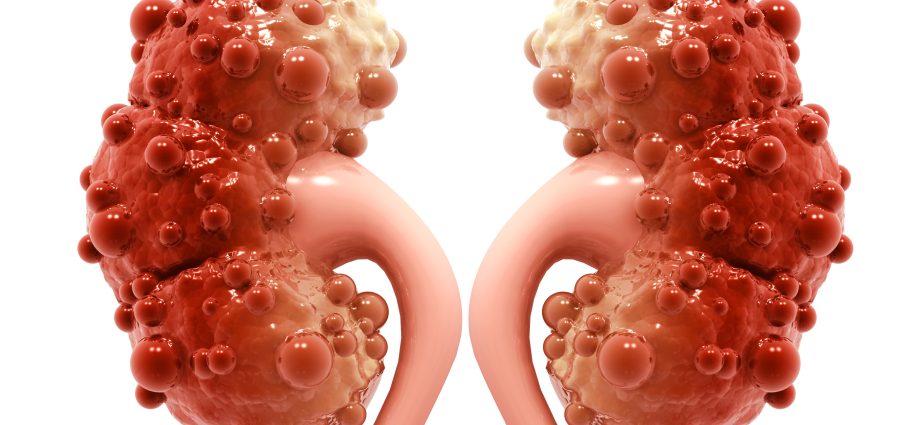 Kidney Cyst &#8211; Is It Dangerous? What are the causes of kidney cysts?