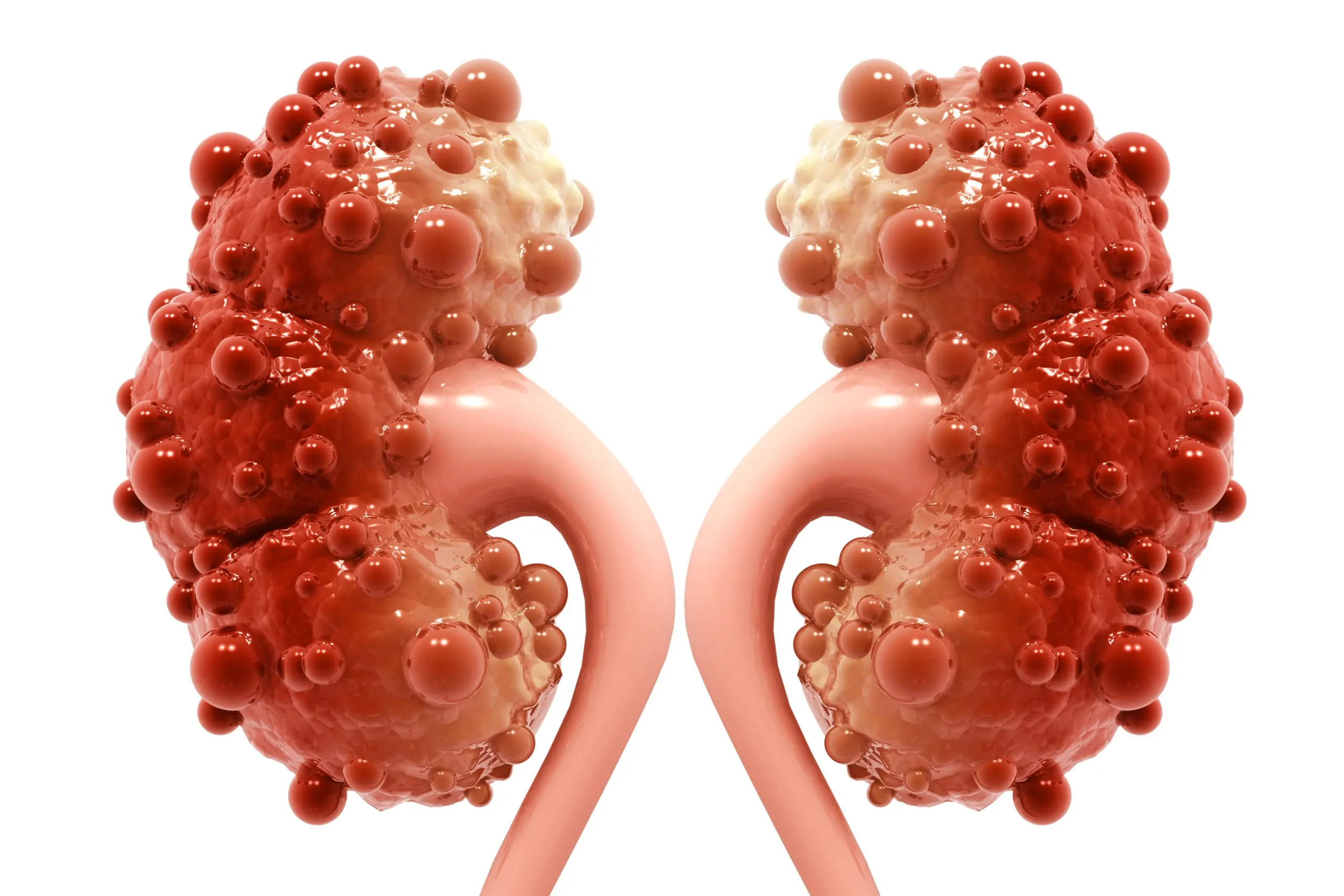 Kidney Cyst &#8211; Is It Dangerous? What are the causes of kidney cysts?