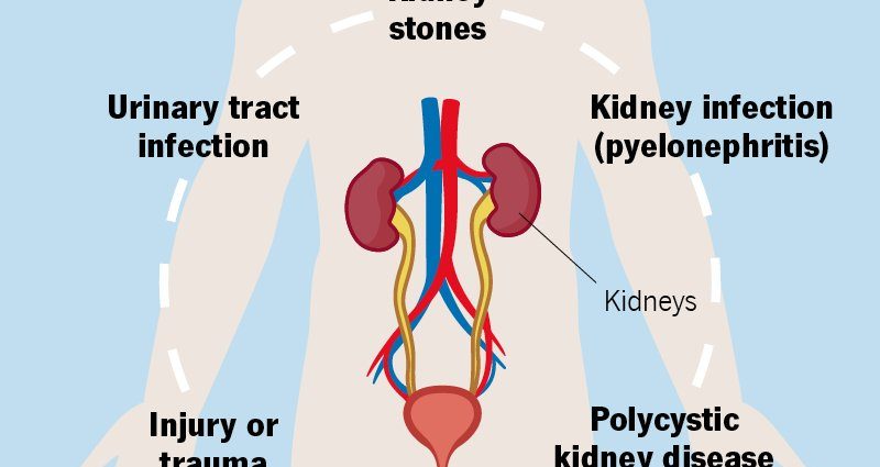 Kidney pain &#8211; causes, diagnosis, treatment. What diseases cause kidney pain?