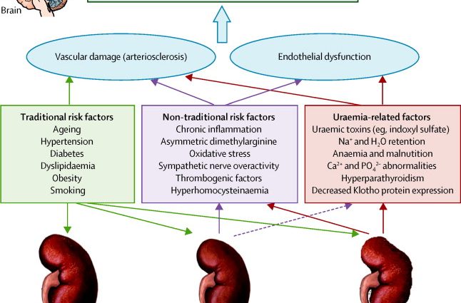 Kidney problems can lead to a stroke