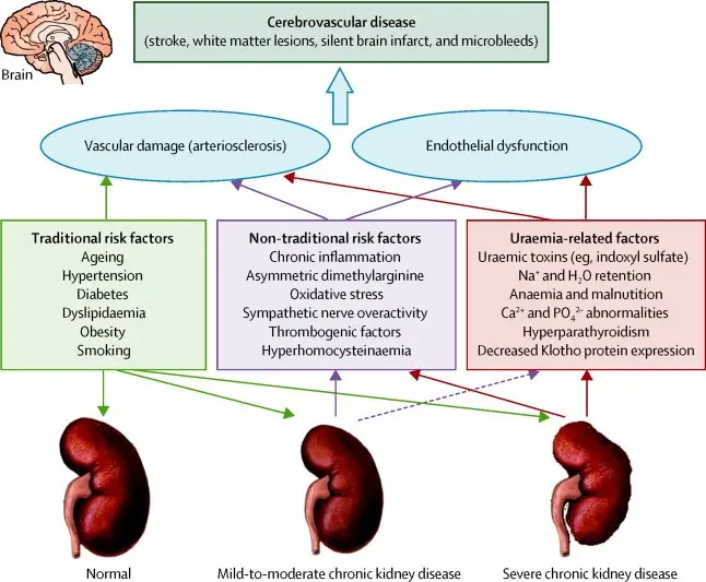 Kidney problems can lead to a stroke