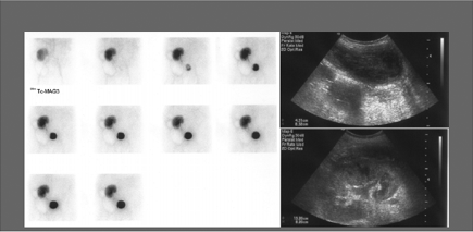 Kidney scintigraphy &#8211; what is it? Indications, contraindications, the course of the examination