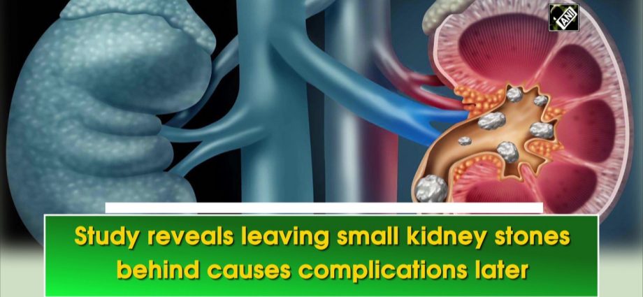 Kidney stones can herald cardiovascular problems