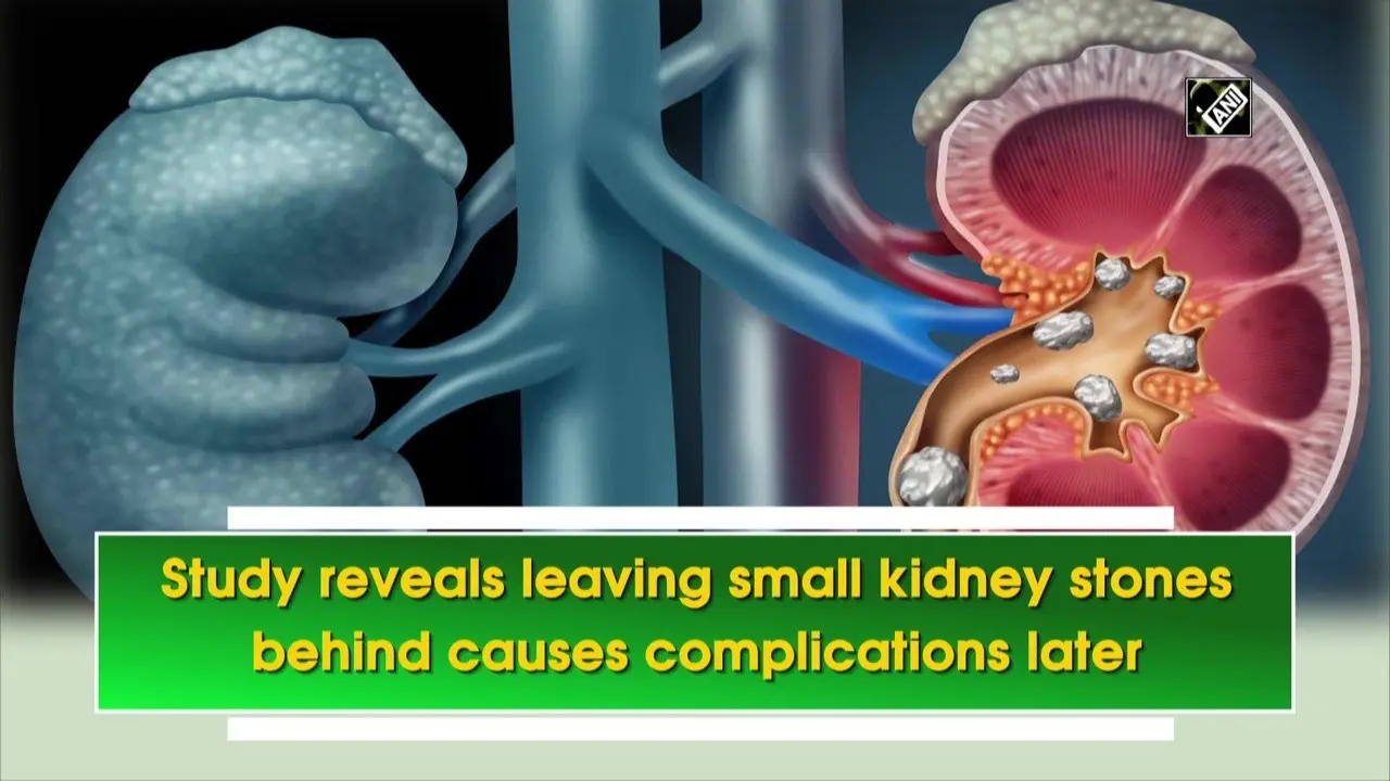 Kidney stones can herald cardiovascular problems