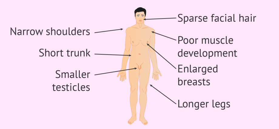 Klinefelter's syndrome (ရောဂါလက္ခဏာ 47၊ XXY) - အကြောင်းတရားများ၊ ရောဂါလက္ခဏာများ၊ ကုသမှု