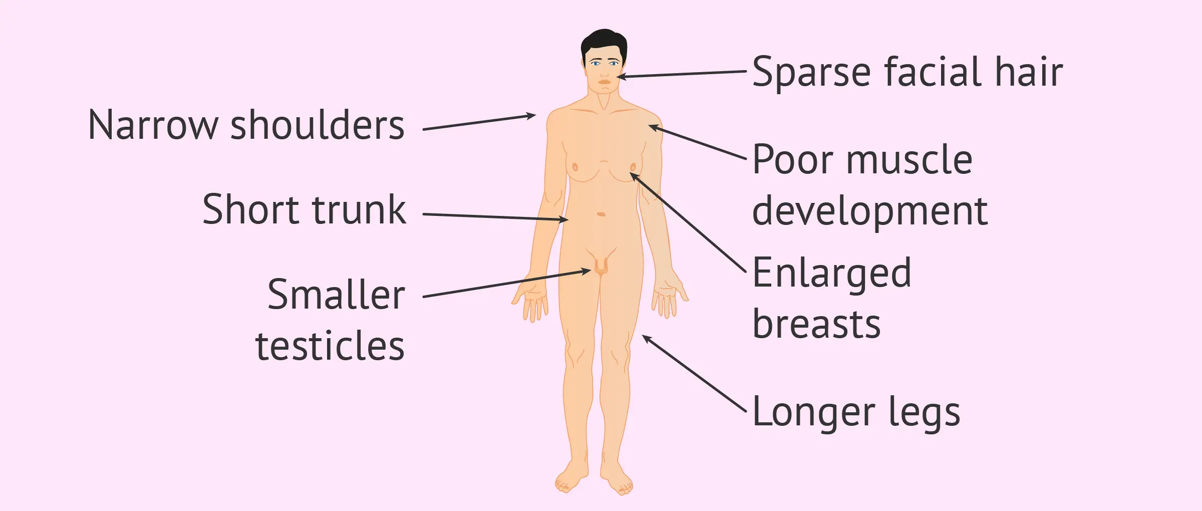 Klinefelter&#8217;s syndrome (syndrome 47, XXY) &#8211; causes, symptoms, treatment