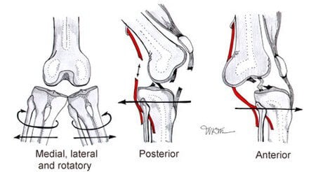 Knee dislocations &#8211; severe knee injuries, treatment