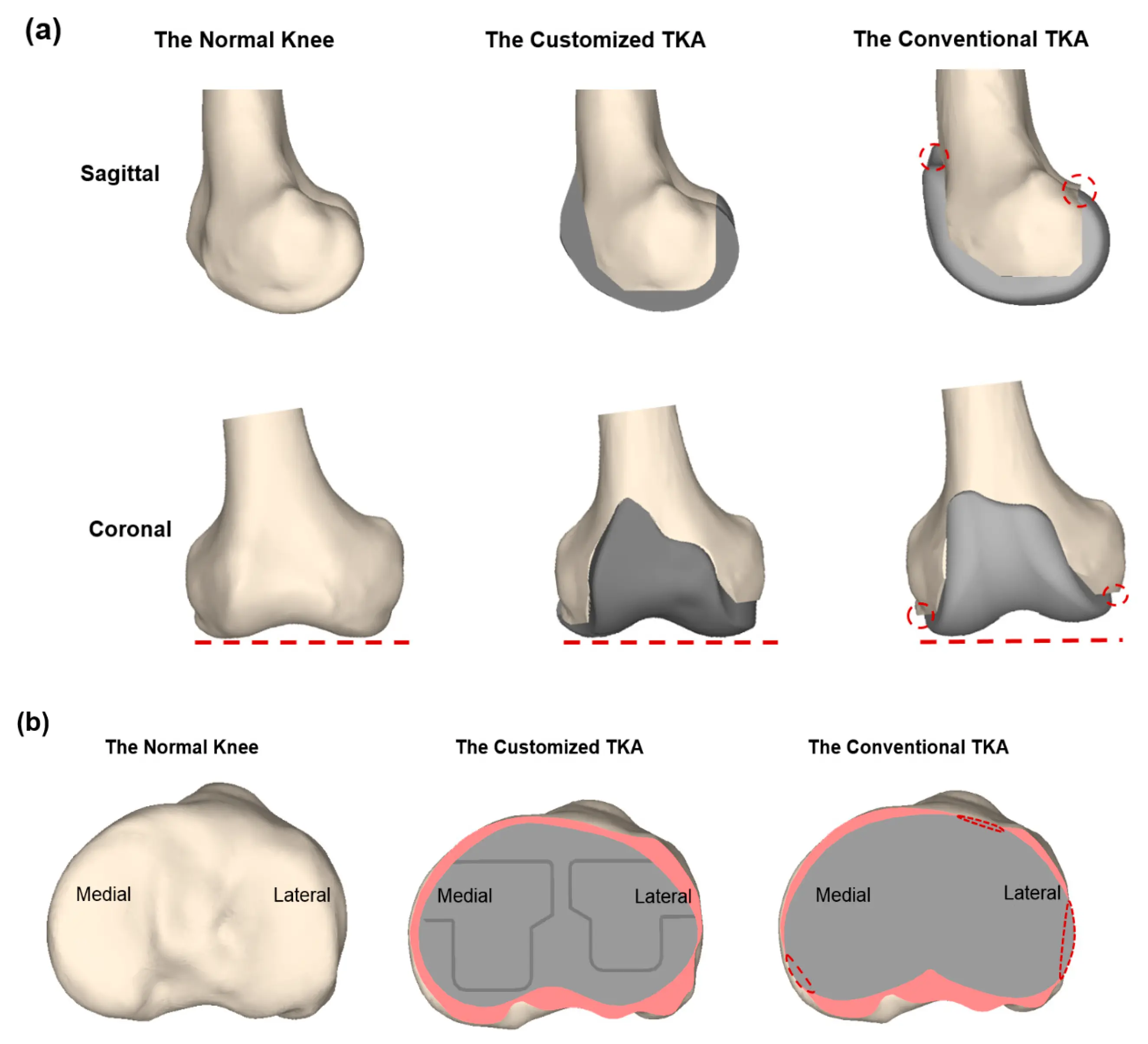 Knee endoprosthesis &#8211; types, consequences of implantation, rehabilitation