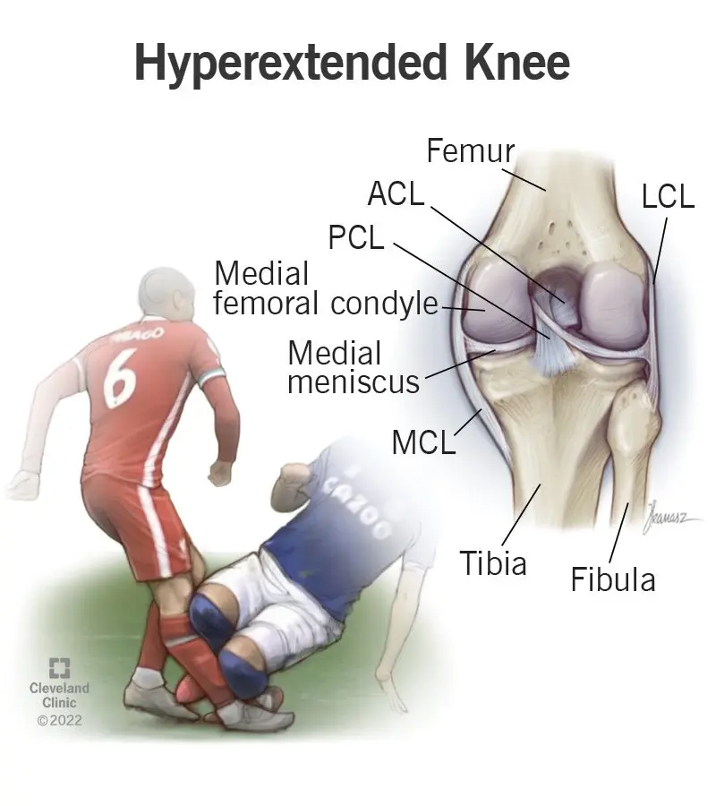 Knee hyperextension &#8211; what does it look like? Treatment of knee hyperextension