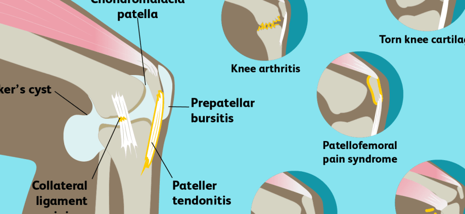 Knee pain &#8211; causes, symptoms, treatment and prevention