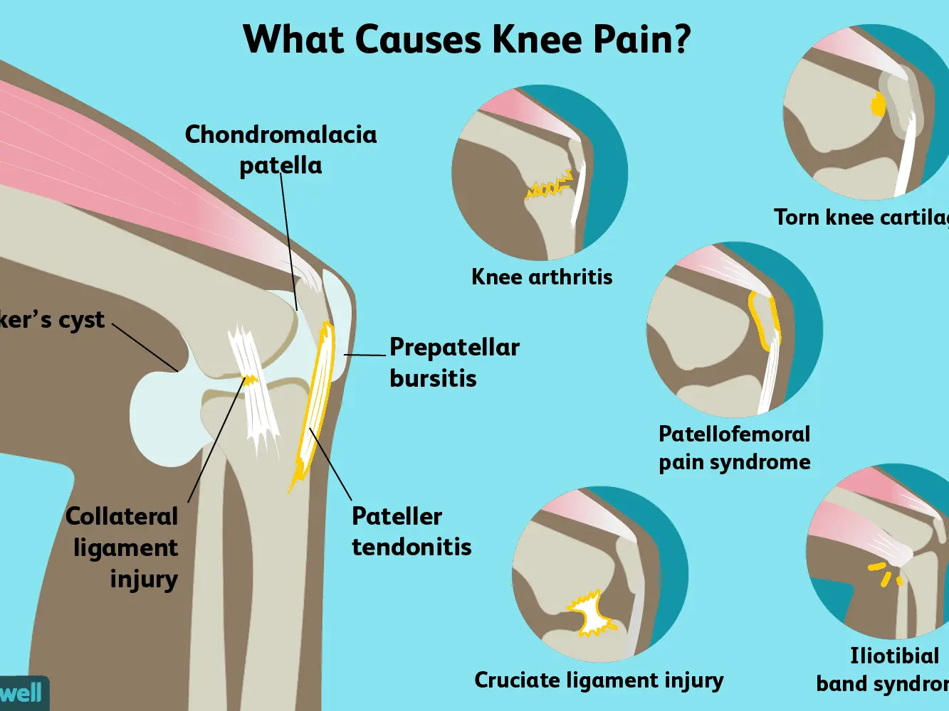 Knee pain &#8211; causes, symptoms, treatment and prevention