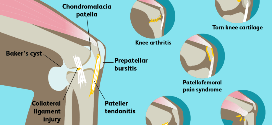 Knee pain when bending &#8211; causes of pain and how to fight it