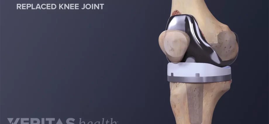 Knee to be replaced?